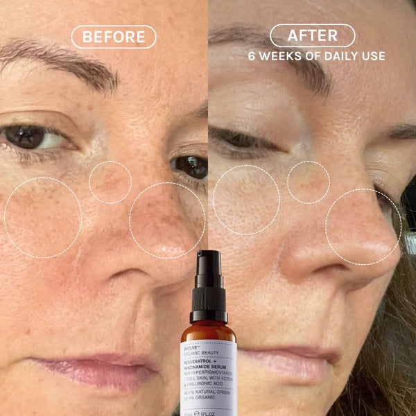 Evolve Beauty Resveratrol + Niacinamide Face Serum for Hyperpigmentation