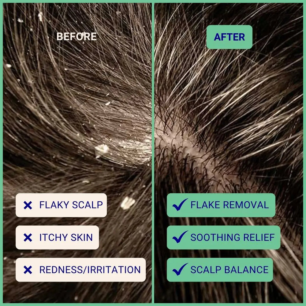 The Powder Shampoo - For Dandruff